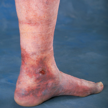 Venous Insufficiency - Vein Clinic of Monterey Bay